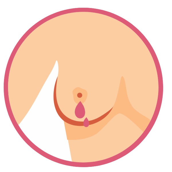 Nipple discharge