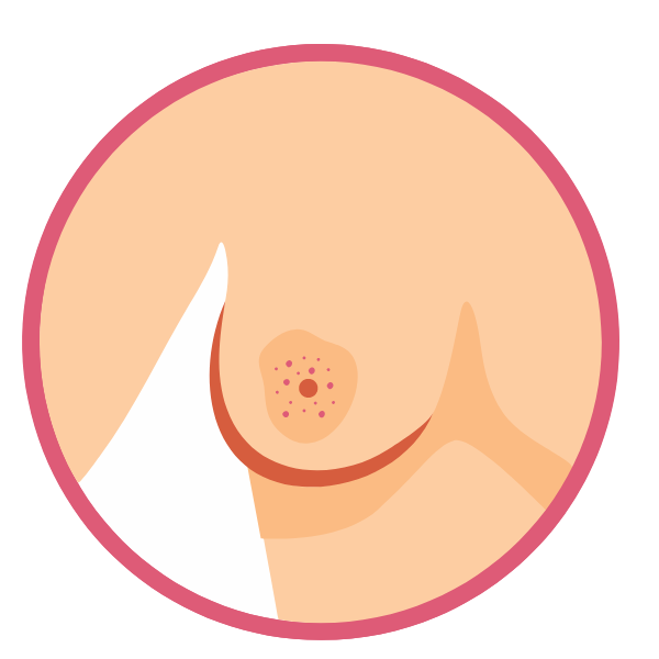 Nipple scaling